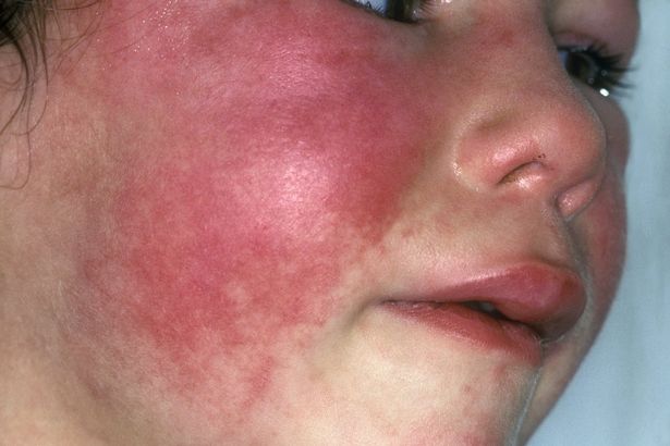 english news scarlet fever