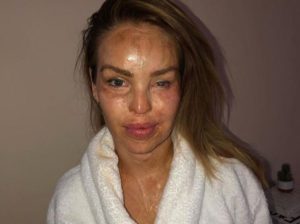 Katie Piper's Acid Attacker Up For Release - “When The Acid Was Thrown ...