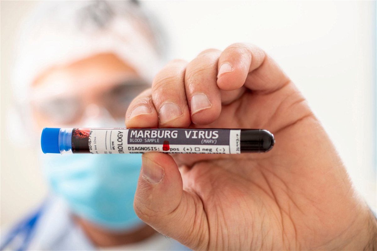 Descartan virus de Marburgo si el paciente es trasladado al Hospital Valdisella de Santander «Euro Weekly News»