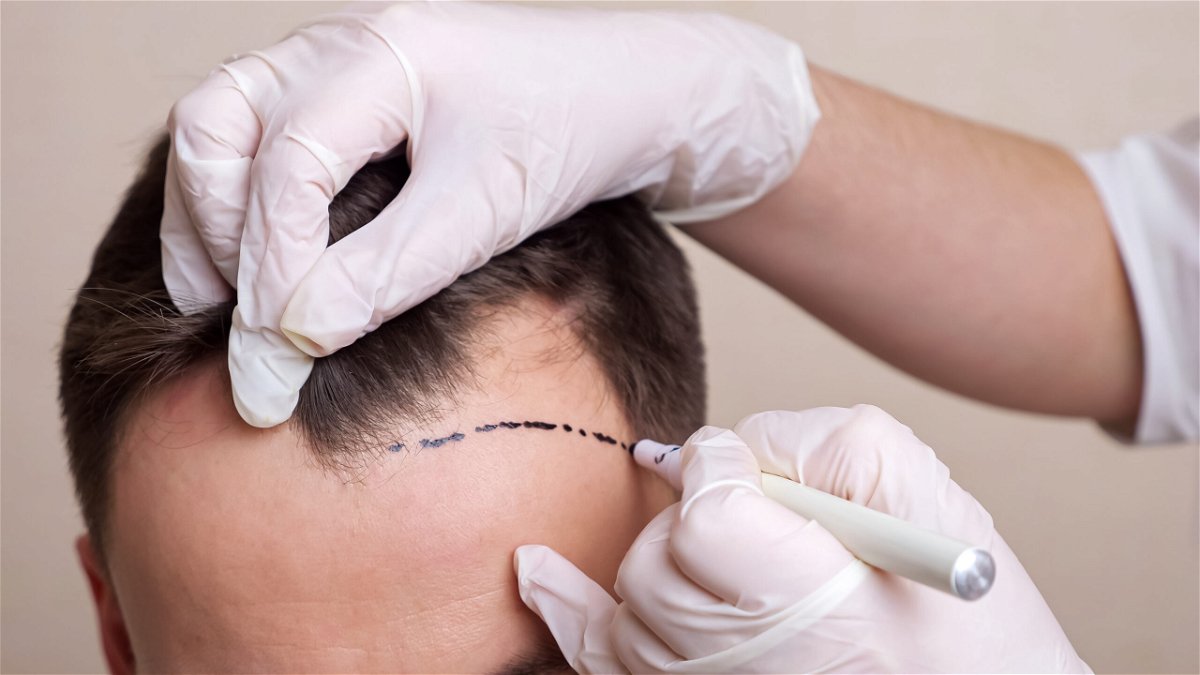 A guide to the 10 best clinics for hair transplants in Spain