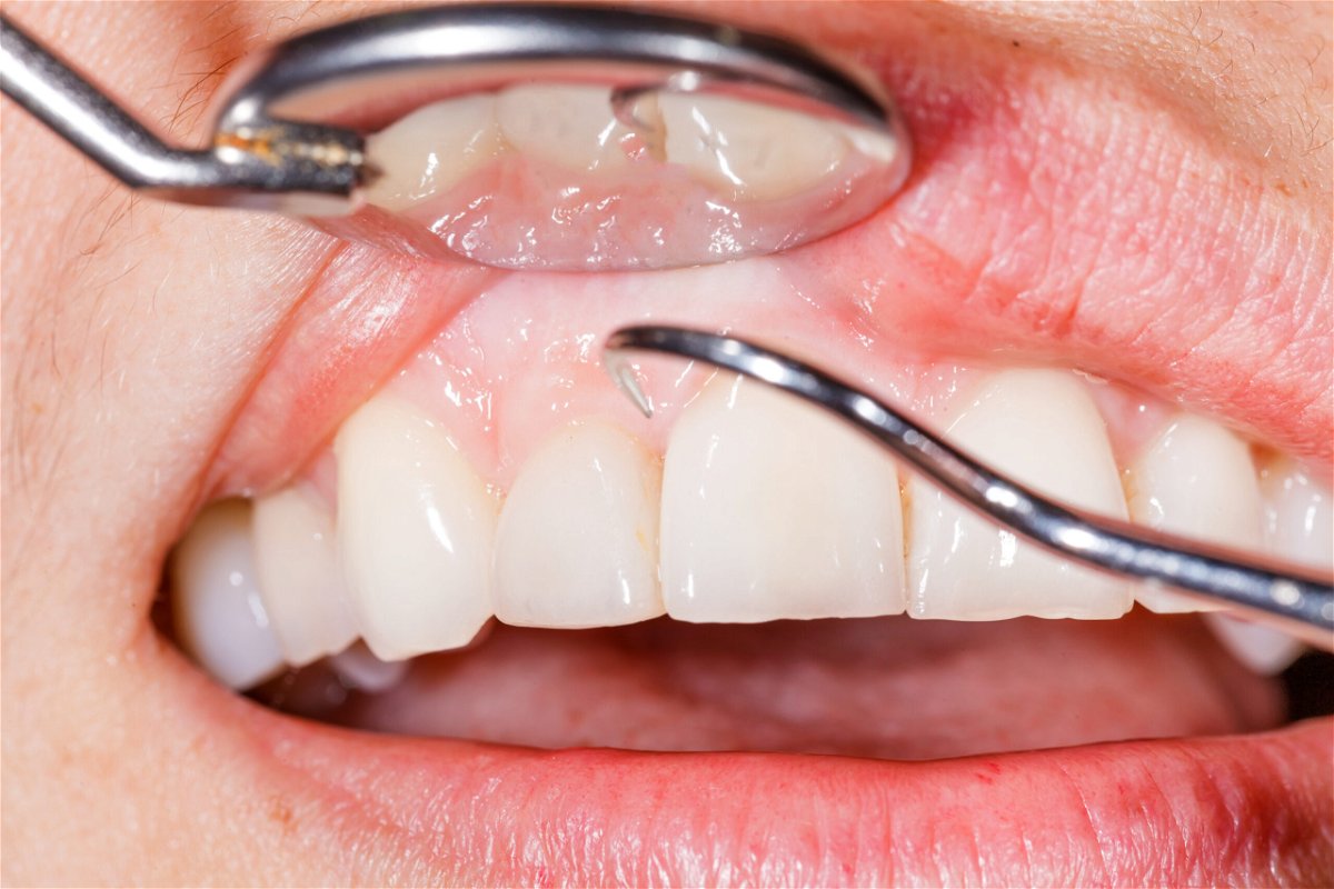 dental clinic spain dental implants