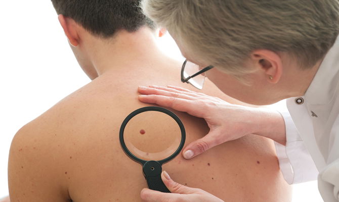 On ‘World Day Against Melanoma’ be aware of the symptoms of this skin cancer