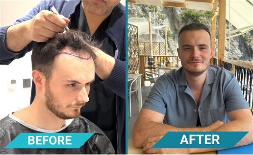 2 pictures side by side before and after shots of a hair transplant