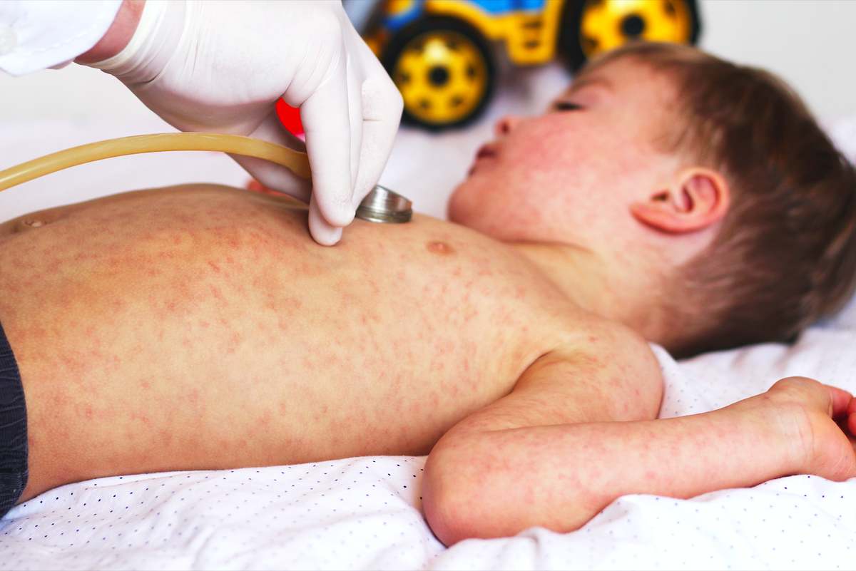 WHO Confirms Loss of Measles Elimination Status in Spain and UK