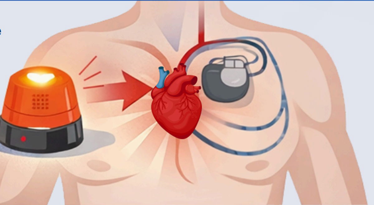 Spain’s mandatory V-16 beacon sparks new health fears for drivers with pacemakers
